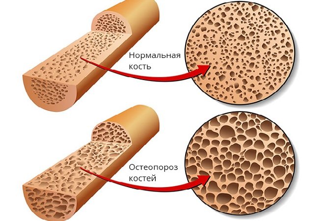 Проявление остеопороза